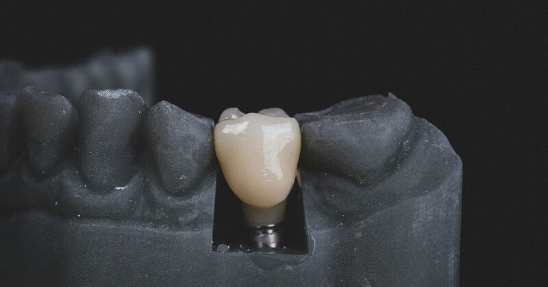 Modelo de trabajo con una corona atornillada sobre un implante dental