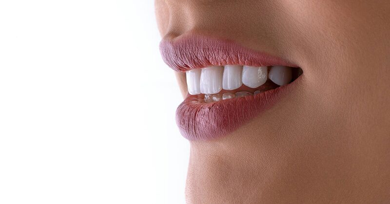 Primer plano de una sonrisa con una férula transparente sobre los dientes inferiores