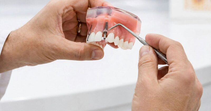 Dentista mostrando una maqueta dental con implantes y una sonda de exploración