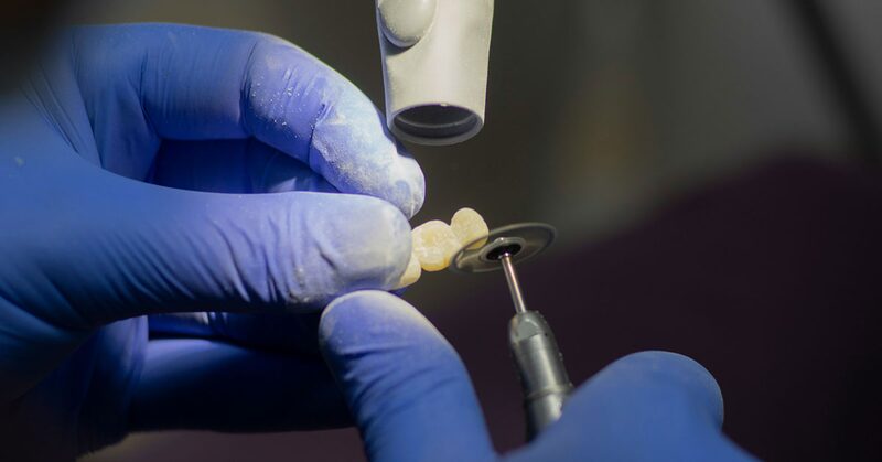 Manos con guantes puliendo una corona dental con una fresa