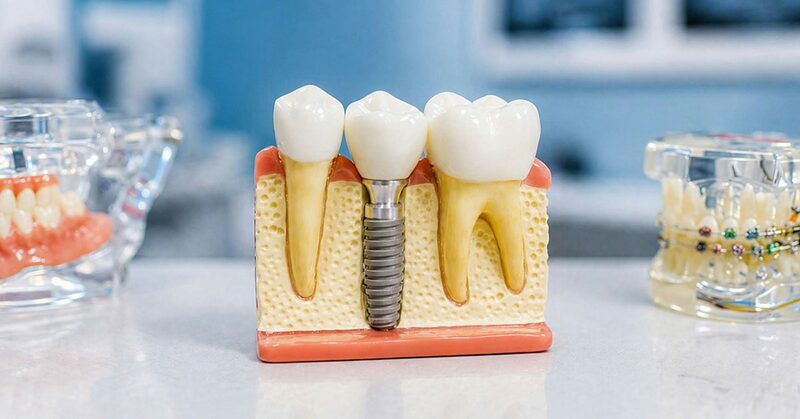 Modelo anatómico de un implante dental atornillado en el hueso, entre dos muelas naturales