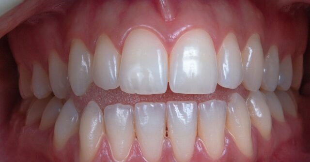Primer plano de una dentadura con las dos arcadas en contacto