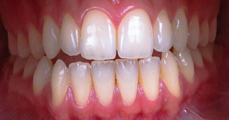 Primer plano de una dentadura con las encías enrojecidas e inflamadas en el margen