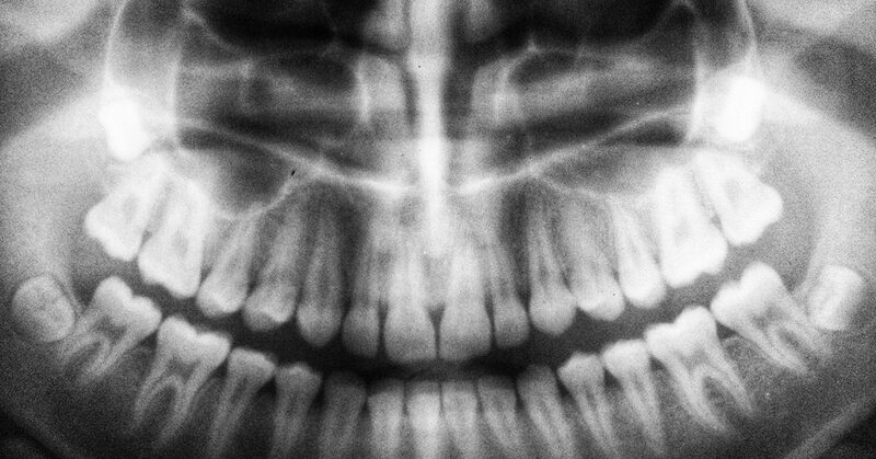 Radiografía panorámica de las dos arcadas con las raíces y el hueso maxilar