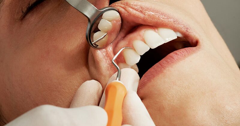 Exploración de la encía con sonda periodontal y espejo durante una revisión