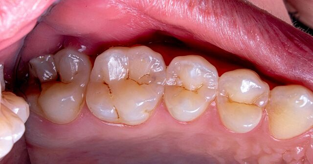 Muelas y encía vistas de cerca durante una exploración periodontal
