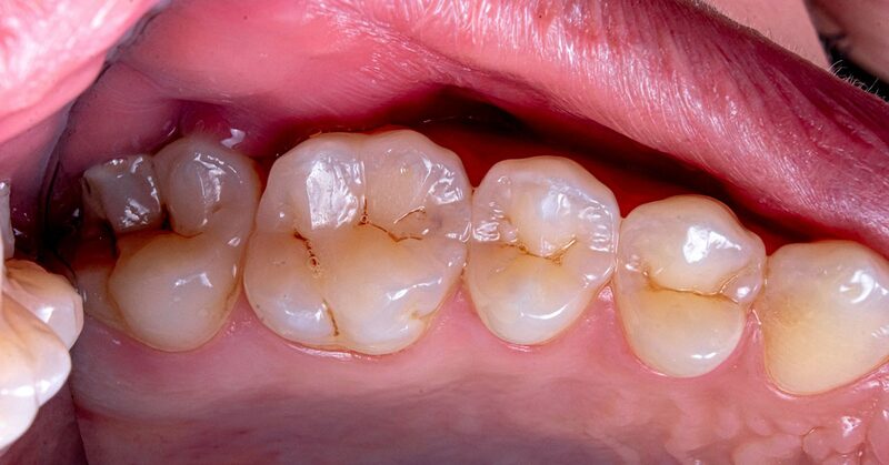 Muelas y encía vistas de cerca durante una exploración periodontal