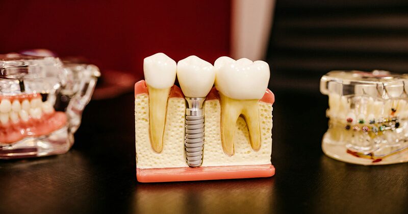 Maqueta de un implante dental colocado en el hueso entre dos dientes naturales