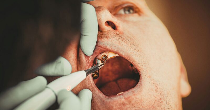 Revisión dental de un paciente con empastes metálicos en las muelas